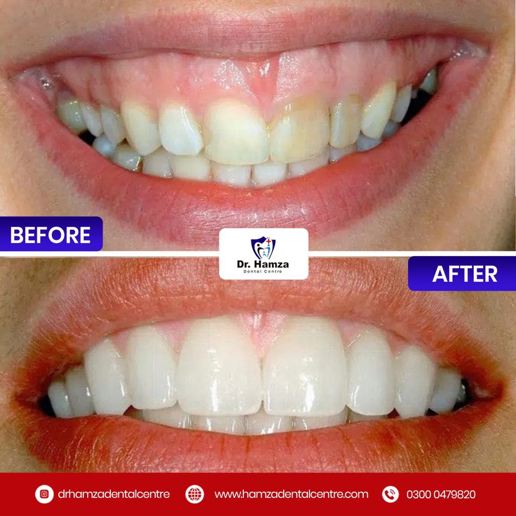 Shining Smile before & after Results