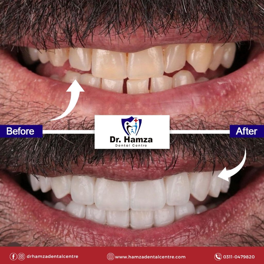 Smile makeover before after results