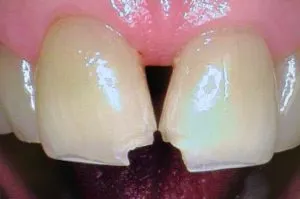 Broken Chipped Tooth