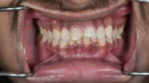 Clinical Case 44
