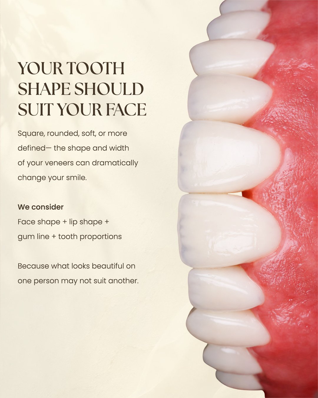 Veneers Offer 3