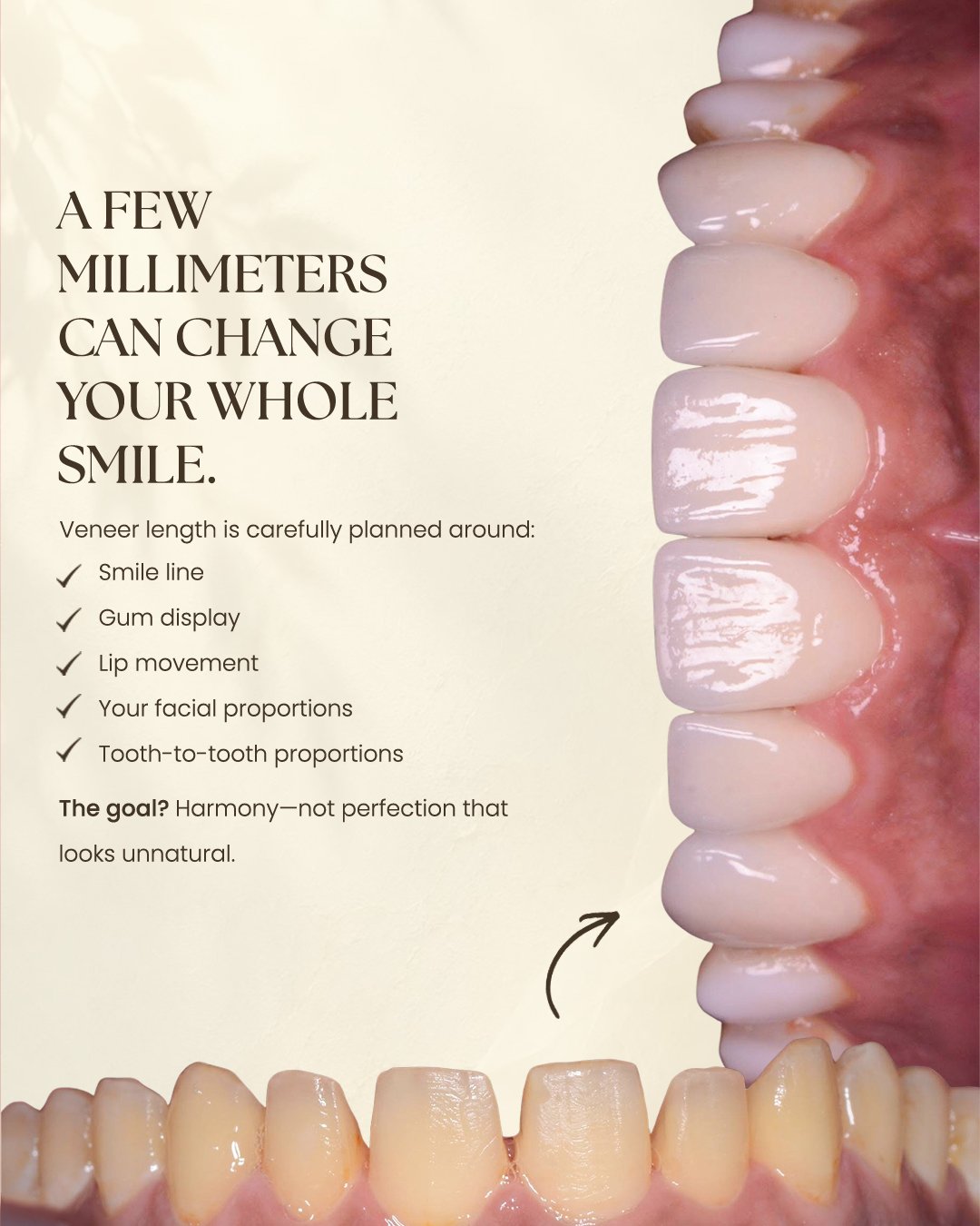 Veneers Offer 4